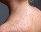Pennsylvania Faces Largest Measles Outbreak in Decades As Case Count Rises to 1,000