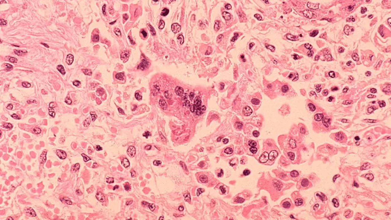 Chester County High School Closed Friday After Confirmed Measles Case