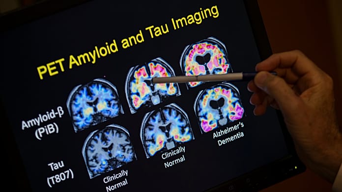 New Molecule Restores Memory in Animals With Alzheimer's' Disease
