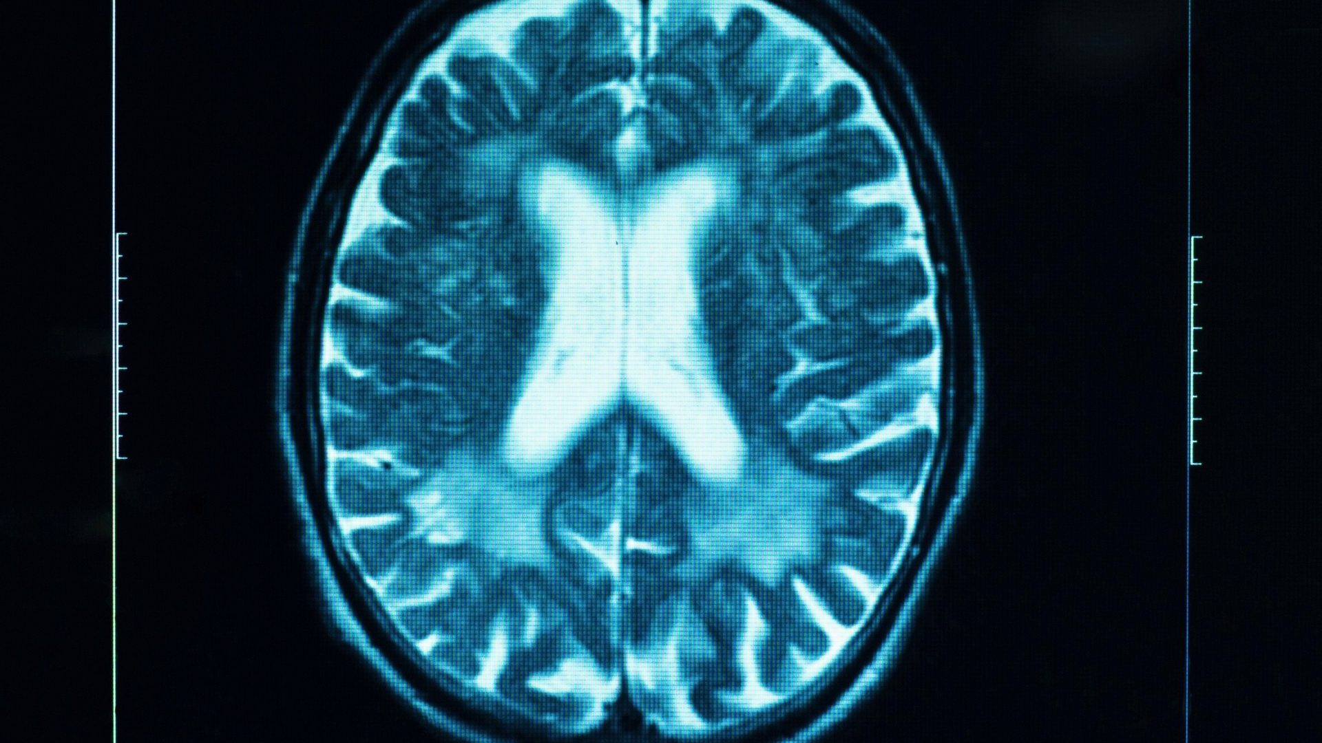 Stroke Recovery May Depend on the Part of the Brain That Wasn't Damaged