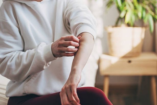 DWP Confirms 25 Skin Conditions Qualifying for PIP After 27,000 People Claim