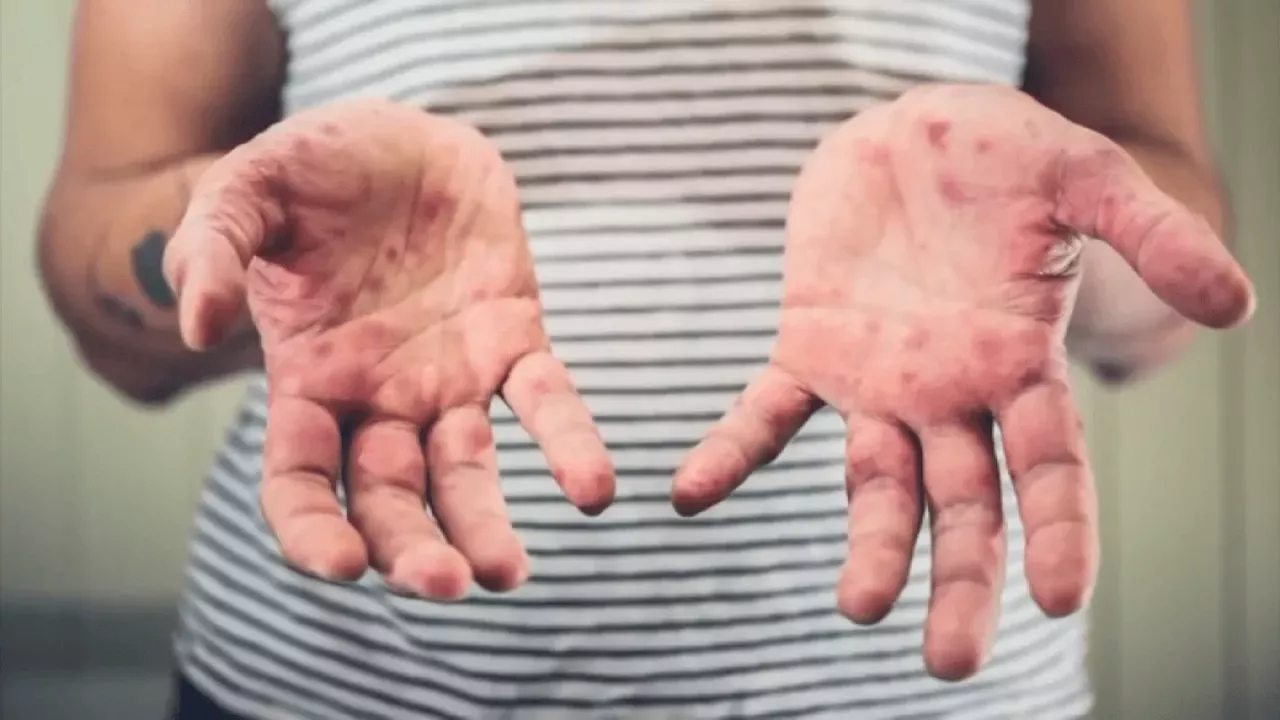 Second measles case confirmed in Kane County, Illinois