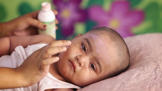Market Developments: Measles outbreak: Death toll reaches 1,122 as 8 more die